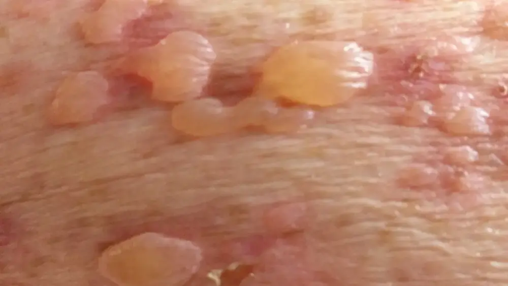 Epidermólise bolhosa: causas, sintomas e tratamento