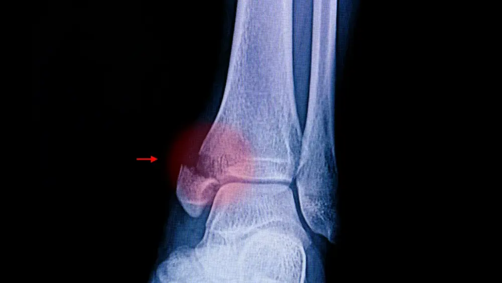 Fraturas do punho: guia completo para entender, prevenir e tratar