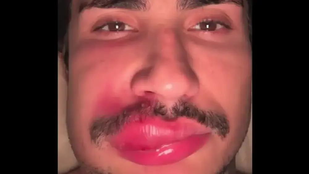 Influenciador quase morre ao espremer espinha
