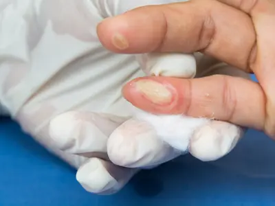 Quais são as causas de bolha no dedo da mão